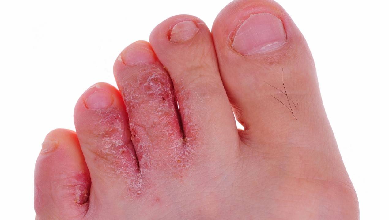 Athlete's Foot