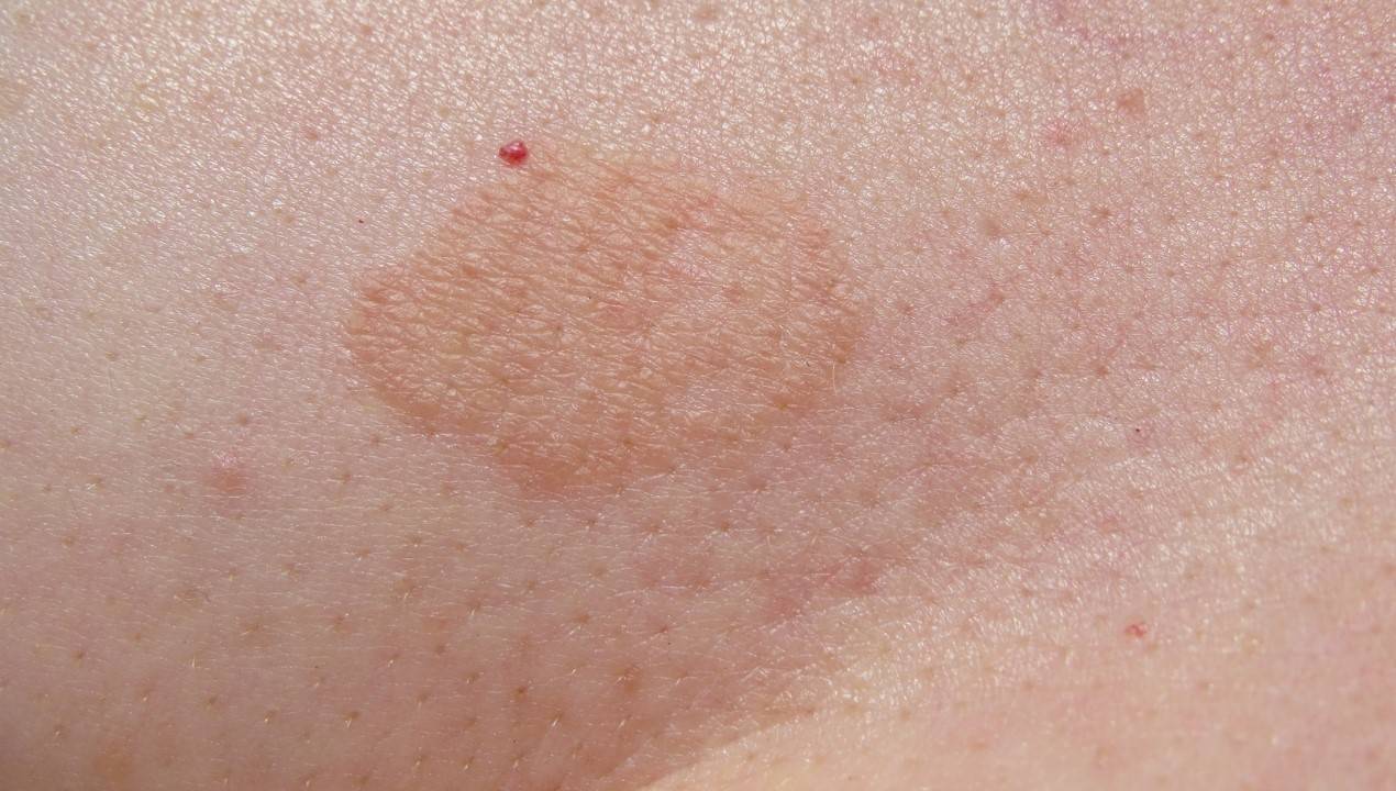 Fungal Skin Infections