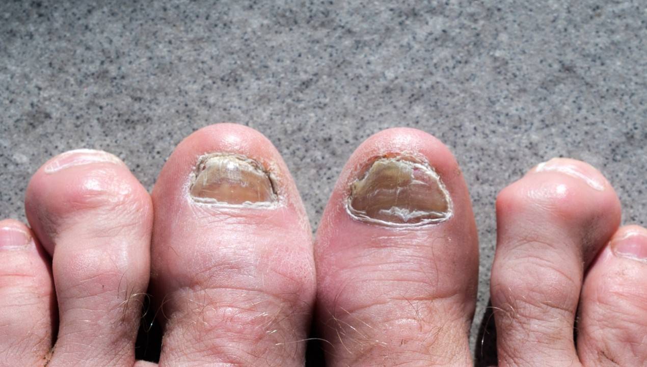 Nail Fungus