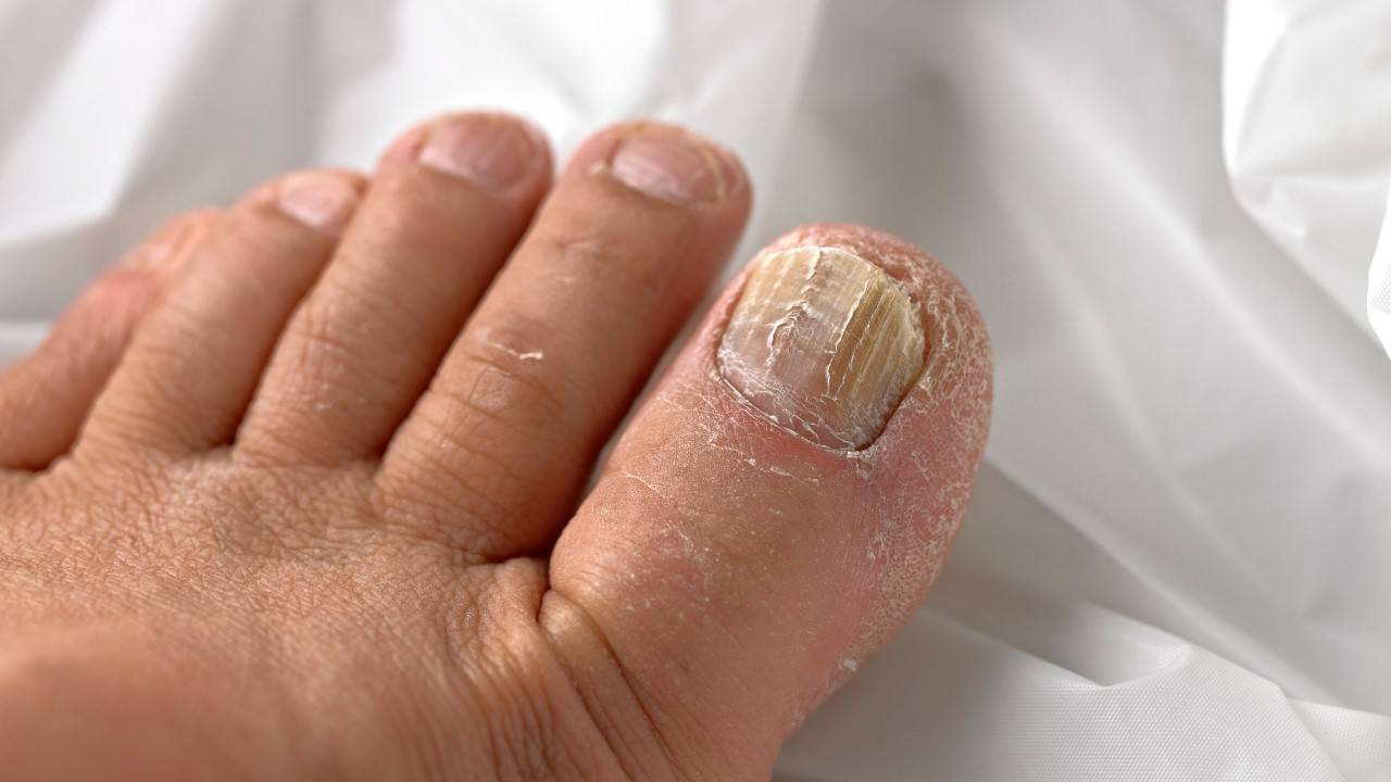 What Exactly isย Early Stage Toenail Fungus